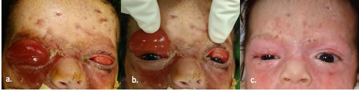 a: Clinical photograph of a 7 days old baby with lamellar ichthyosis, showing complete eversion of the right upper eyelid with markedly chemosed conjunctiva. Upper lid ectropion is also present in the left eye. b: On retraction of the upper eyelids, normal cornea is seen. 2c. Clinical photograph of the baby at 2 weeks follow up after medical management and eyelid taping, showing complete resolution of the ectropion in both the eyes