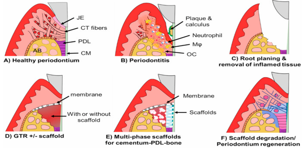 Diagramatic illustration of healthy periodontium, periodontitis, and scaffold-based regenerative approaches. A) Healthy periodontium consisting of of junctional epithelium (JE), connective tissue (CT) fibers, cementum (CM), periodontal ligament (PDL) and alveolar bone (AB). B) Deposition of dental plaque & calculus resulting in inflammatory response (infilteration of neutrophils and macrophages ultimately leading to periodontitis C) removal of calculus, necrotic CM and granulation tissue. D) GTR approach with or without scaffolds. E) Regenerative therapy with Multi-phase scaffolds. F)The scaffolds undergo degradation process as new tissues forms.