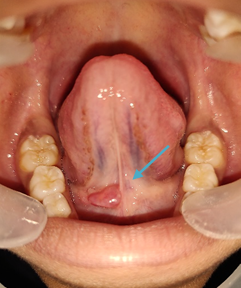 Pre-operative photograph-Intraoral clinical appearance of lesion.