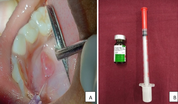 A) Mucous aspiration by 18-gauge needle and syringe B) 1ml of Betamethasone injection and 31 gauge insulin syringe.