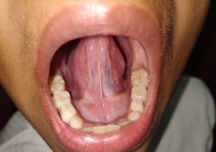 Seven days post operative photograph.