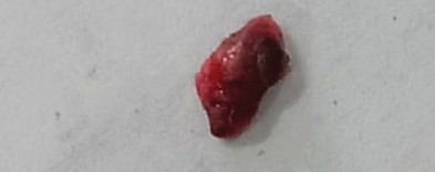 Nodule removed in-toto (8 mm in size)