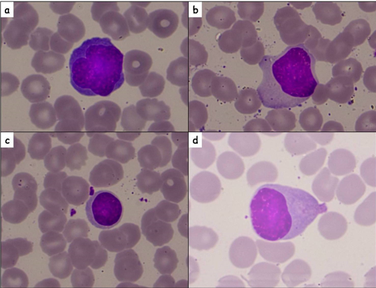 Reactive lymphocyte on peripheral smear:(a): Downey type I [Leishman stain, X1000]; (b): Downey type II [Leishman stain, X1000]; (c): Downey type III [Leishman stain, X1000]; (d): Plasmacytoid lymphocyte [Leishman stain, X1000].