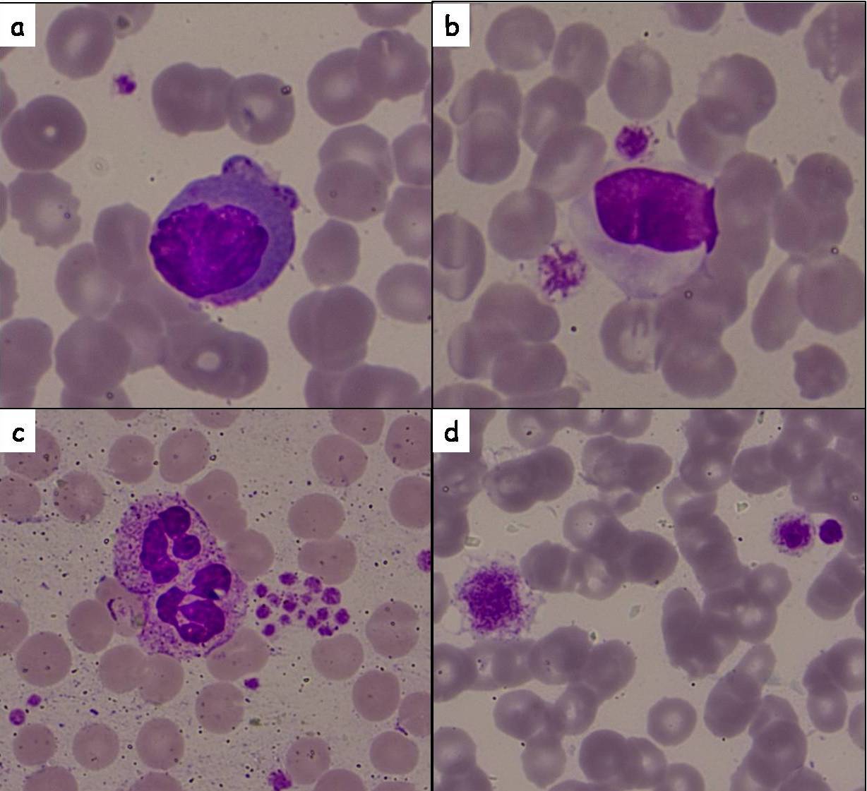 Platelet morphology on peripheral smear: (a),(b) & (c): Platelet-leucocyte aggregrates [Leishman stain, X1000]; (d): Macrothrombocyte [Leishman stain, X1000]