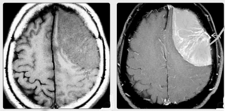 CT scan revealed isodense left convexity mass in left fronto-parietal region with uniform enhancement suggestive of a meningiomatous lesion.