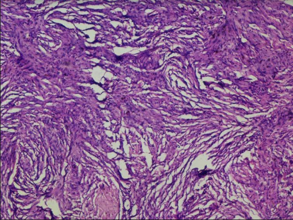 Meningothelial meningioma: Sections showed lobular architecture containing meningothelial whorls formed by syncytial cells with indistinct cell membranes, eosinophilic cytoplasm and round uniform nuclei with intra-nuclear pseudo inclusions. Haematoxylin and eosin x10X.