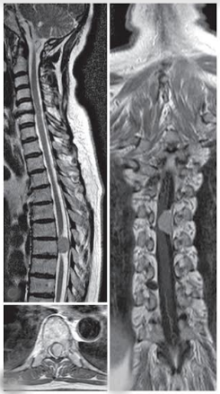 MRI spine revealed around extra medullary intradural mass at T7 level which was relatively hyperintense to spinal cord on sagittal sections view with intense post- contrast enhancement, with a provisional diagnosis of mid-thoracic meningioma.