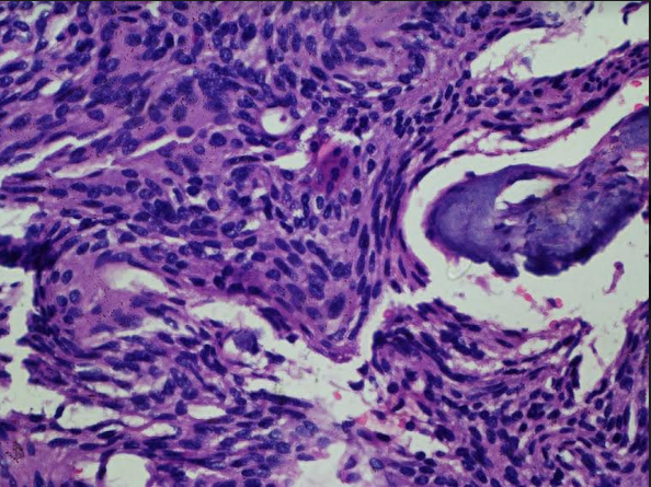 Psammomatous meningioma: Section showed whorls of round to oval tumor cells with numerous psammoma bodies, with areas of fibrocollagenous tissue with dilated and congested blood vessels and mixed inflammatory infiltrate. Haematoxylin and eosin x40X.