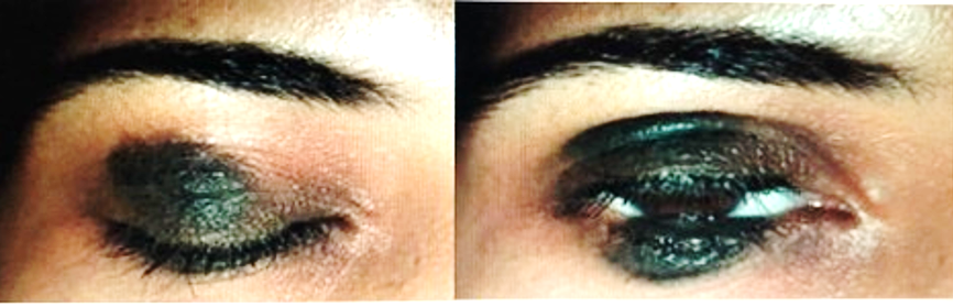 Kissing nevus of the right eyelid and looking like as one whole nevus on attempted eyelid closure