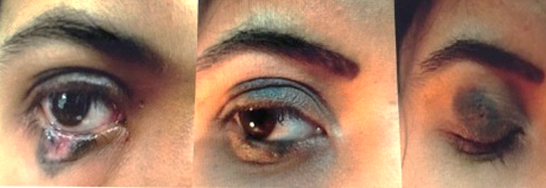 Partial resolution of nevus after 1st sitting of radiofrequency ablation