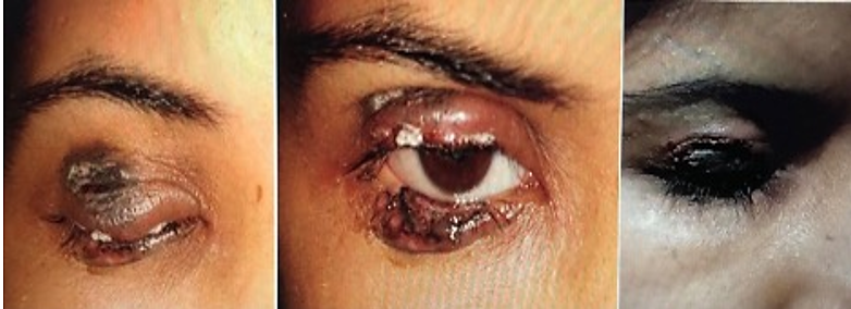 Immediate postoperative after the second sitting of radiofrequency ablation