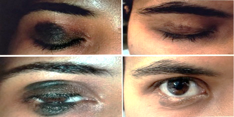 Nevus before and after treatment with CO2 laser