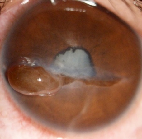 Full thickness corneal tear with uveal tissue prolapse