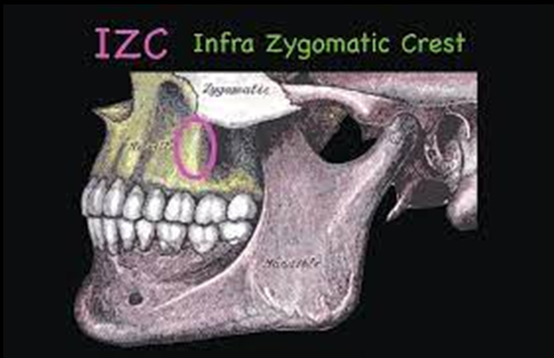 Skeletal anatomy of infrazygomatic crest.
