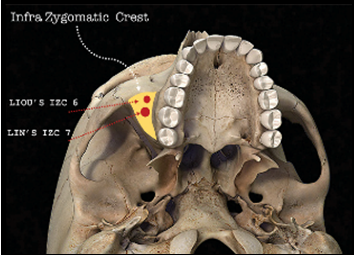 Sites for the placement of bone screws in the IZC