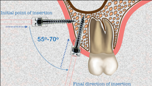 Consideration during the placement of IZC bone screws