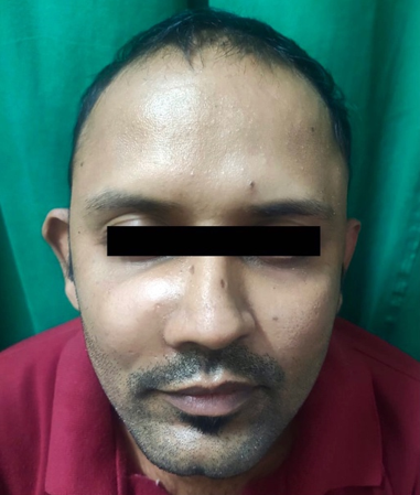 Preoperative photograph showing right maxillary swelling