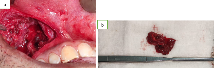 a,b: Loculated mass – right maxilla
