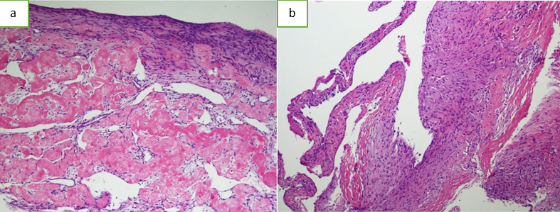 a,b: Histology showing loose fibroblasts in the cyst wall and giant cells