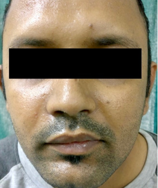 Postoperative photograph (after one month of surgery)
