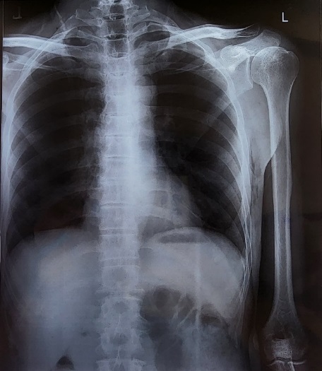 X-ray image– x-ray image ap view of left shoulder preoperatively