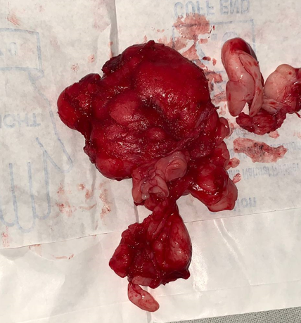 En bloc excision of tumour - Operative Image of En bloc excision of tumour intraoperatively of patient.