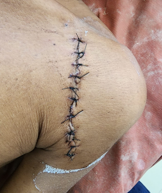 Postoperative scar - Clinical photograph of operated site on POD 12 of patient.