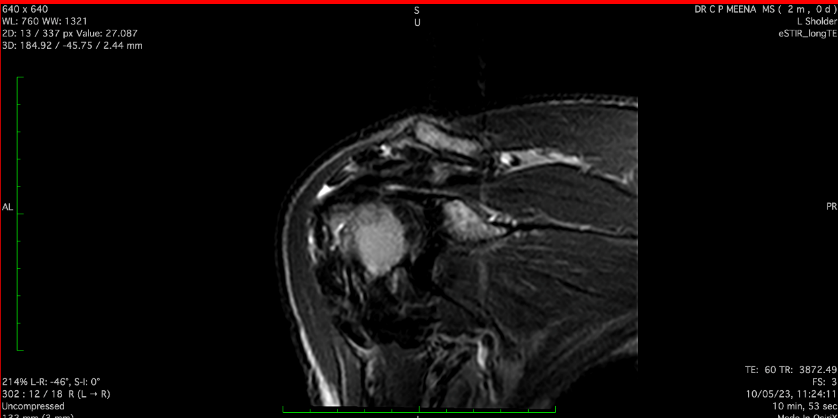 MRI Image STIR Long - MRI image of coronal section of left shoulder joint STIR long image preoperatively