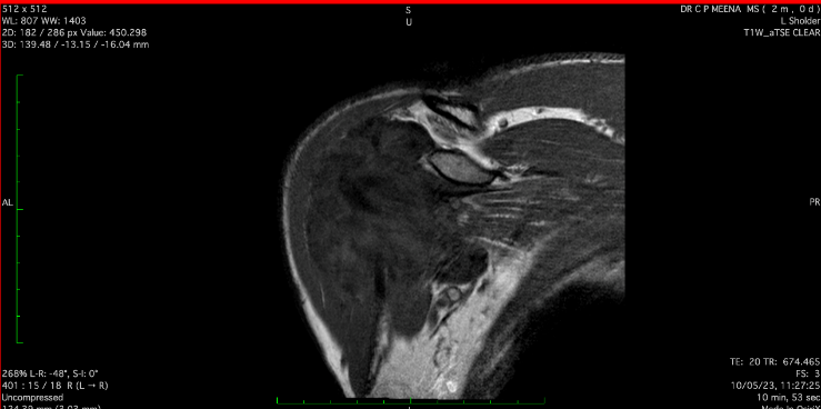 MRI Image T1W - MRI image of coronal section of left shoulder jointT1W image preoperatively