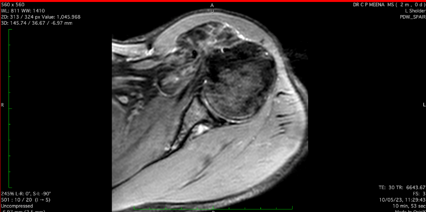 MRIimage SPAIR - MRI image of axial section of left shoulder Joint SPAIR image preoperatively