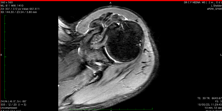MRIimage eSPAIR - MRI image of axial section of left shoulder joint extended SPAIR Image preoperatively