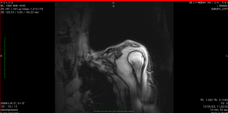MRI image localizer- MRI image of coronal section of left shoulder joint localizer image preoperatively.
