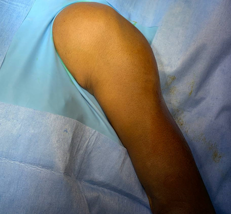 Intraoperative draping - Operative image of intraoperative draping of patient