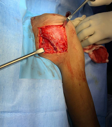 Dissection of Planes - Operative Image of Dissection of Planes, localization of Cephalic VeinIntraoperatively of Patient