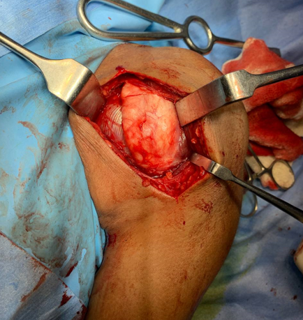 Localization of tumour - Operative image of tumour in situ intraoperatively of patient