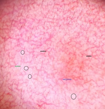 Branched vessels (black arrow), Y shaped vessels (blue arrow), serpentine vessels (green arrow), white structureless areas (black circle) on dermoscopy.
