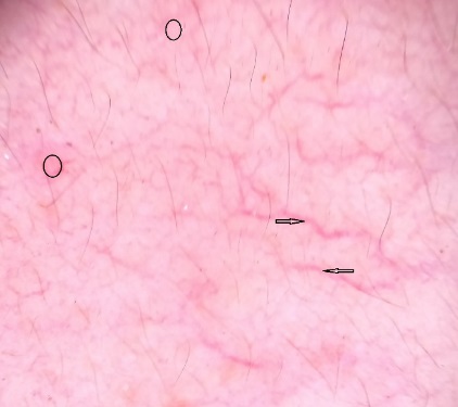 Pink structureless areas (black circles), linear vessels (black arrows) on dermoscopy.