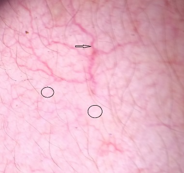 Polygonal vessel (black arrow) and white structureless areas (black circle) on dermoscopy.