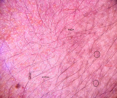 Brown globules (black circles) with an exaggerated pigment network, white hair (black arrow), hypertrichosis (red arrow) on dermoscopy.