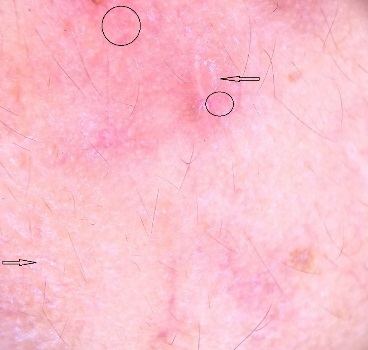 Red diffuse areas (black circles), scaling (black arrows) on dermoscopy.