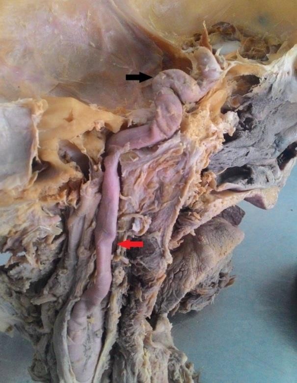 Redundant curvature (shown in black arrow)of cavernous part of the artery associated with aneurysm (red arrow)