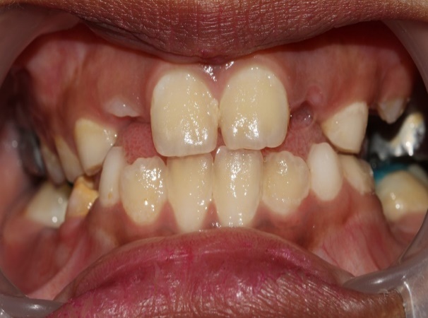 Frontal view revealing correction ofcrossbite with 21 and 31 at one week.