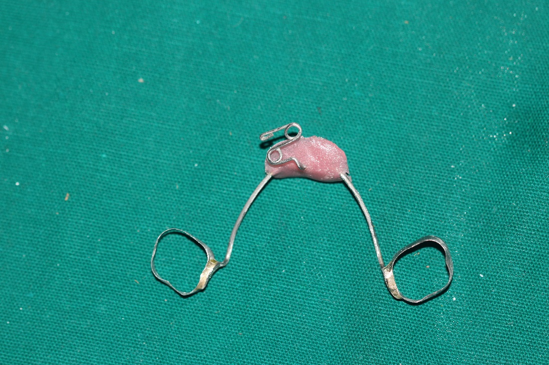 Modified Nance palatal appliance with Z spring.