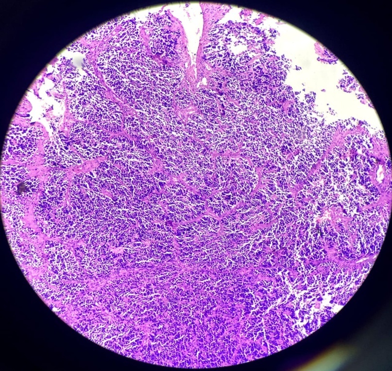 Densely packed cells arranged in nests and lobules separated by fibrous septa