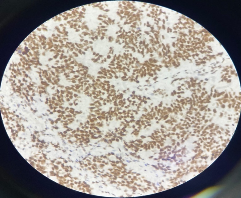 IHC of INI-1: retained