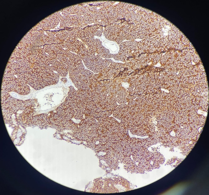 IHC image of synaptophysin- positive
