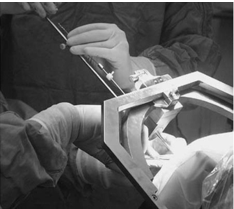 Insertion of a DBS electrode