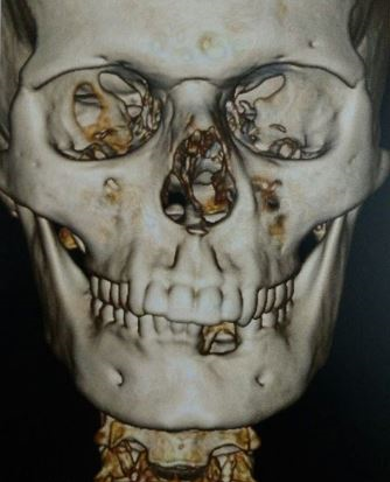 3D Reconstruction of computed tomography scan showing bone involvement