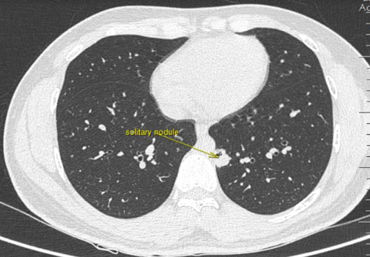 HRCT chest showing cavitating solitary nodule in the lung