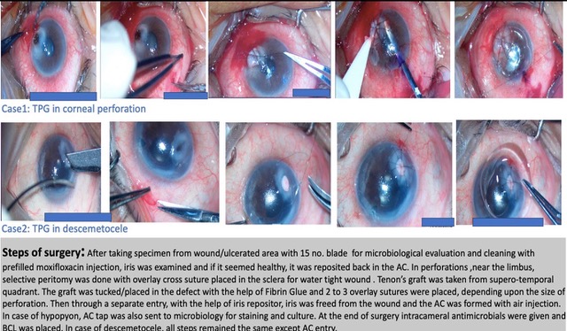 Surgical steps of TPG